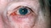 Ocular Rosacea Symptoms Include Itch, Foreign Body Sensations