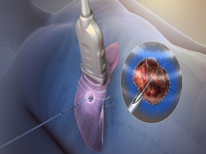 Short, High-Power Ablation on Par With Standard AF Ablation