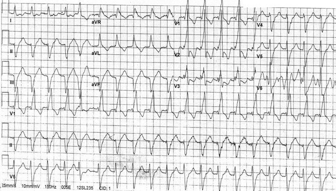 ECG Challenge: Heart Racing and Probable Heart Failure