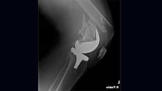 How to Prevent a Feared Complication After Joint Replacement