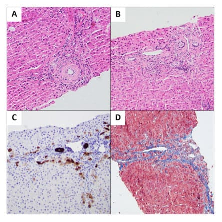 A 19-Year-Old With Hypercholesterolemia, Transaminitis, and IBD - Page 4