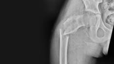 Falls in the Elderly: Causes, Injuries, and Prevention