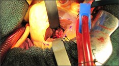 Keys to Diagnosing Broken Heart Syndrome (Takotsubo Cardiomyopathy)