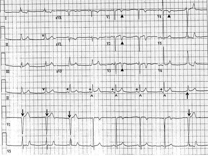 ECG Challenge: Longer-Lasting Chest Pains in Cardiac Patient - Page 2