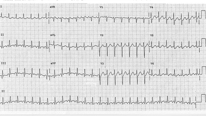 ECG Challenge: Wheezing With a Rapid Heartbeat