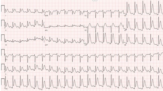 Chest Pain in a Cancer Patient - Page 2