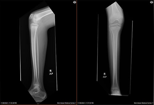 An 11-Year-Old Girl With Bilateral Leg Pain and Ecchymosis - Page 2