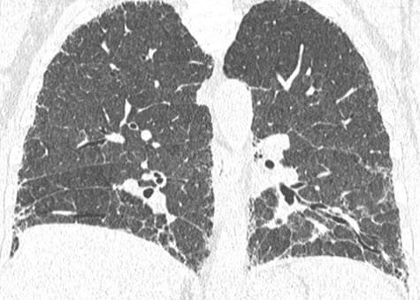A Truck Driver With Progressive Dyspnea and Cough - Page 3