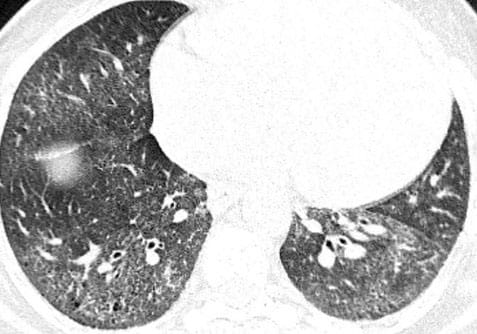 A Truck Driver With Progressive Dyspnea And Cough - Page 4