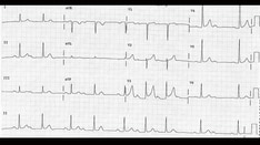 ECG Challenge: C diff Infection With Irregular Pulse