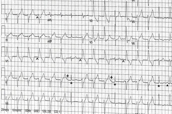 ECG Challenge: Fever After Oral Surgery in a Cardiac Patient - Page 2