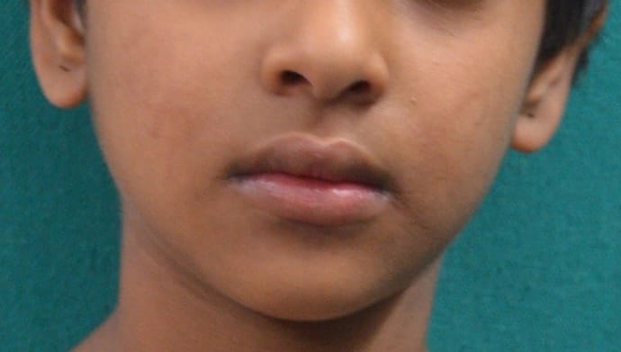 A 7-Year-Old With a Rash on Her Face and Extremities Present Since ...