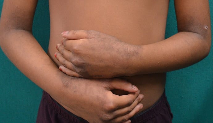 A 7-Year-Old With a Rash on Her Face and Extremities Present Since ...