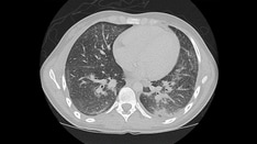 A 19-Year-Old Woman With Fever, Cough, and Dyspnea at Rest