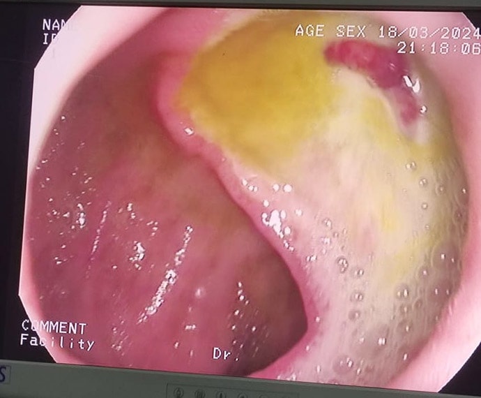 https://img.medscapestatic.com/thumbnail_library/ht_240621_fig1_gastro_endoscopy_690x570.jpg