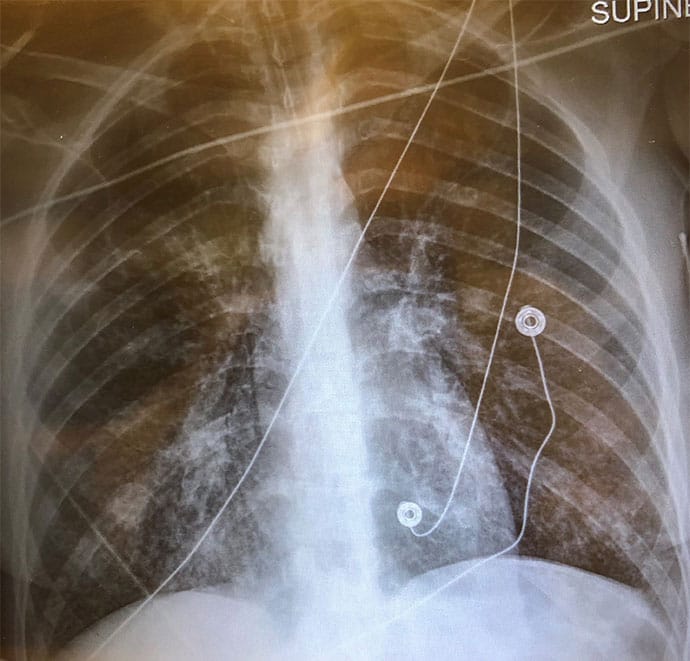 Massive Hemoptysis - Page 2