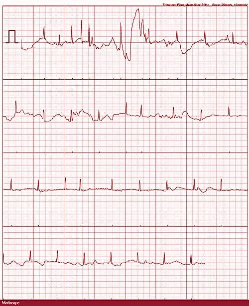 apple watch ecg examples