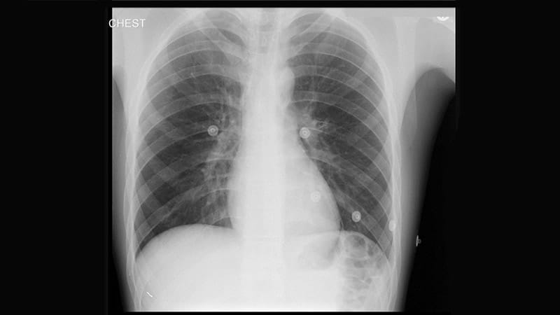 Single Chest X-Ray Could Predict 10-Year CVD Risk