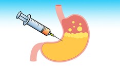 Botulism Cases Linked to Intragastric Injections for Obesity