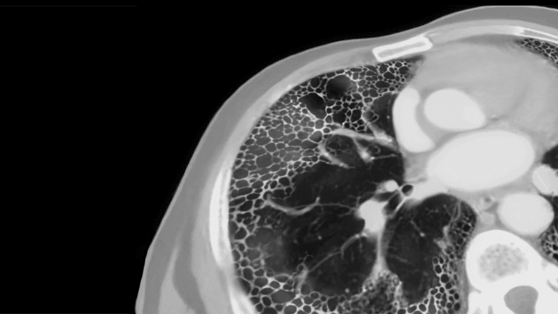 Early Start: Strategies to Improve Outcomes in IPF