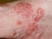 Not All Biologics Equally Safe for Patients With Psoriasis