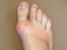 Gout: Guidance Issued on Treat-to-Target