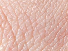 Diagnosing and Treating Rheumatic Skin Disorders