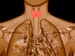 Thyroid Cancer Subtype Reclassified as Noncancer