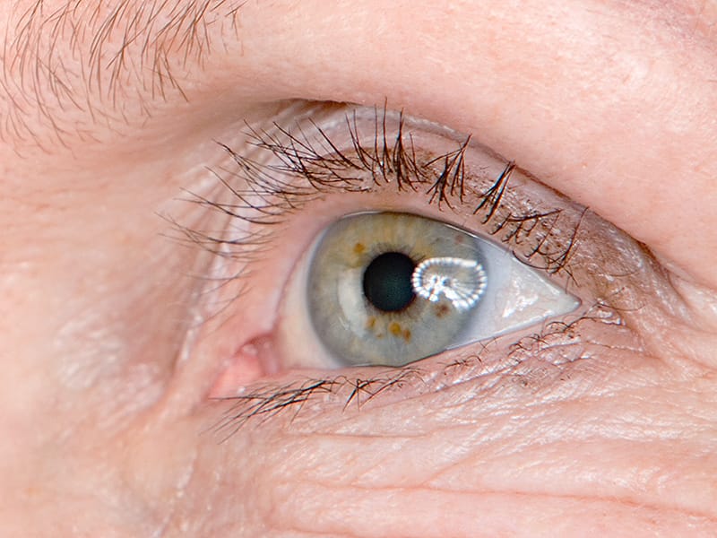 Is Age-Related Macular Degeneration Declining? 