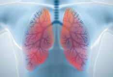 Idiopathic Pulmonary Fibrosis Clinical Presentation 