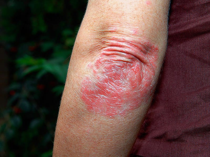 Biological Therapies and Improvements in QoL in Psoriasis
