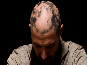 JAK Inhibitors Promising for Alopecia Areata