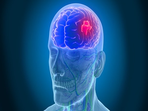 Stroke Risk Increases for 3 Months, Not 1, After MI