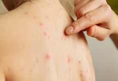 herpes facialis