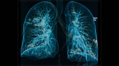 Funding Boost Call to Tackle UK's 'Shameful' Lung Disease Record