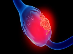 PARP Inhibitors Move Into First-Line for Ovarian Cancer