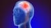 Low Cholesterol Linked to Higher Hemorrhagic Stroke Risk