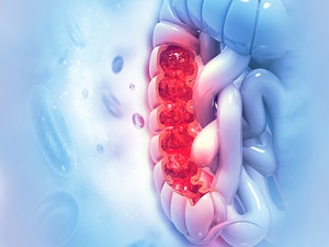 Should Routine Colon Cancer Screening Start at 45, Not 50?