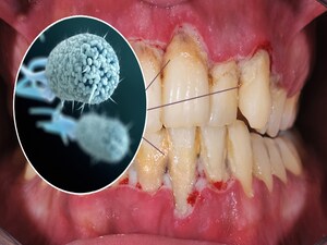 Gum Disease Bacteria a Novel Treatment Target for Alzheimer's?