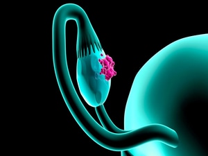 New OS Data With Olaparib Support 'New Era' for Ovarian Cancer