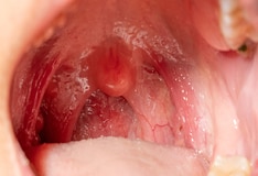 throat cancer from hpv 16)