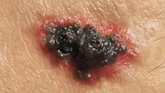 Specialty-Trained Pathologists More Likely to Make Higher-Grade Diagnoses for Melanocytic Lesions