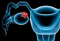 endometrial cancer medscape hpv cancer gorge
