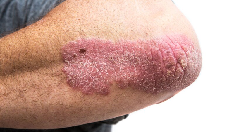 Topical Tapinarof Effective in Pivotal Psoriasis Trials