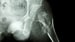 Osteoporosis Underdiagnosed in Older Men With Fracture