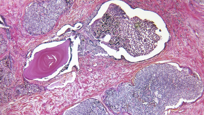 Longer Survival With Sipuleucel-T in Advanced Prostate Cancer