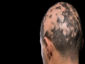 New Trial Data Show Hair Growth in More Alopecia Areata Patients