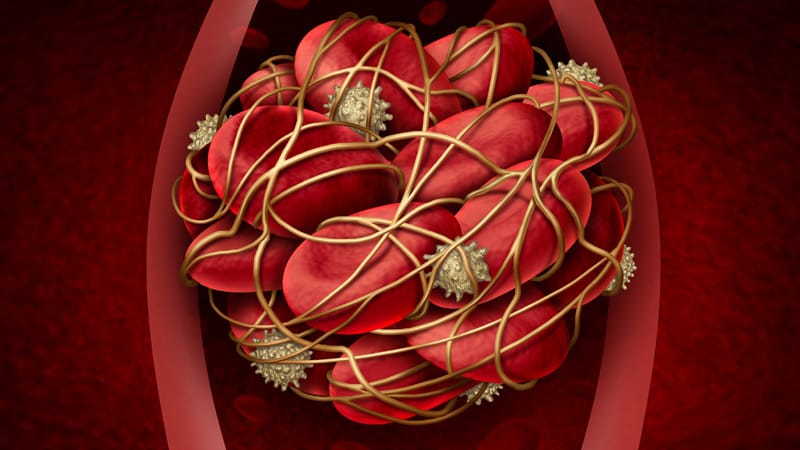 New ASH Guidelines: VTE Prevention, Treatment in Cancer Patients