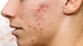 FDA Approves Triple Combination Topical Treatment for Acne
