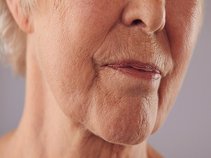 Device That Combines US, RF Promising for Wrinkles, Skin Laxity